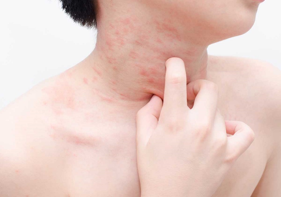 Dị ứng da có thể xảy ra khi sử dụng nệm dính máu lâu ngày